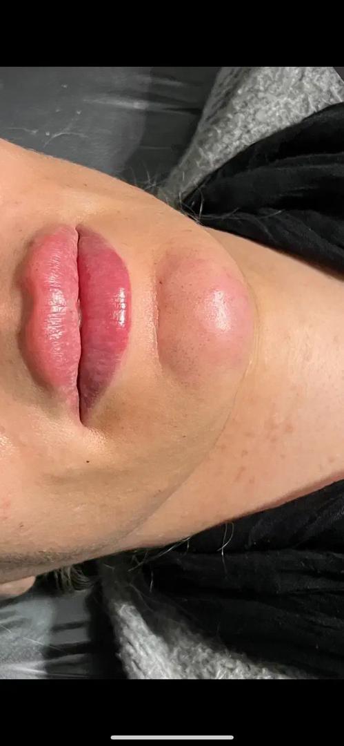 تزریق فیلر زیر چشم بینی لب در اصفهان