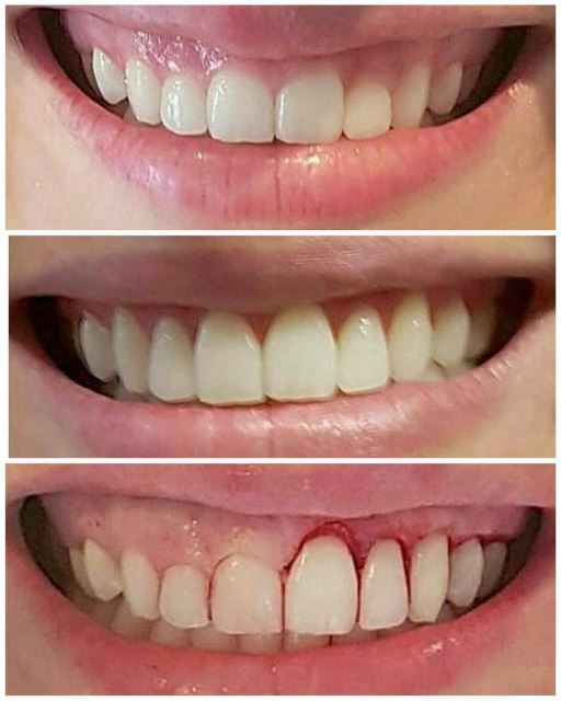 لیفت لثه در تهران