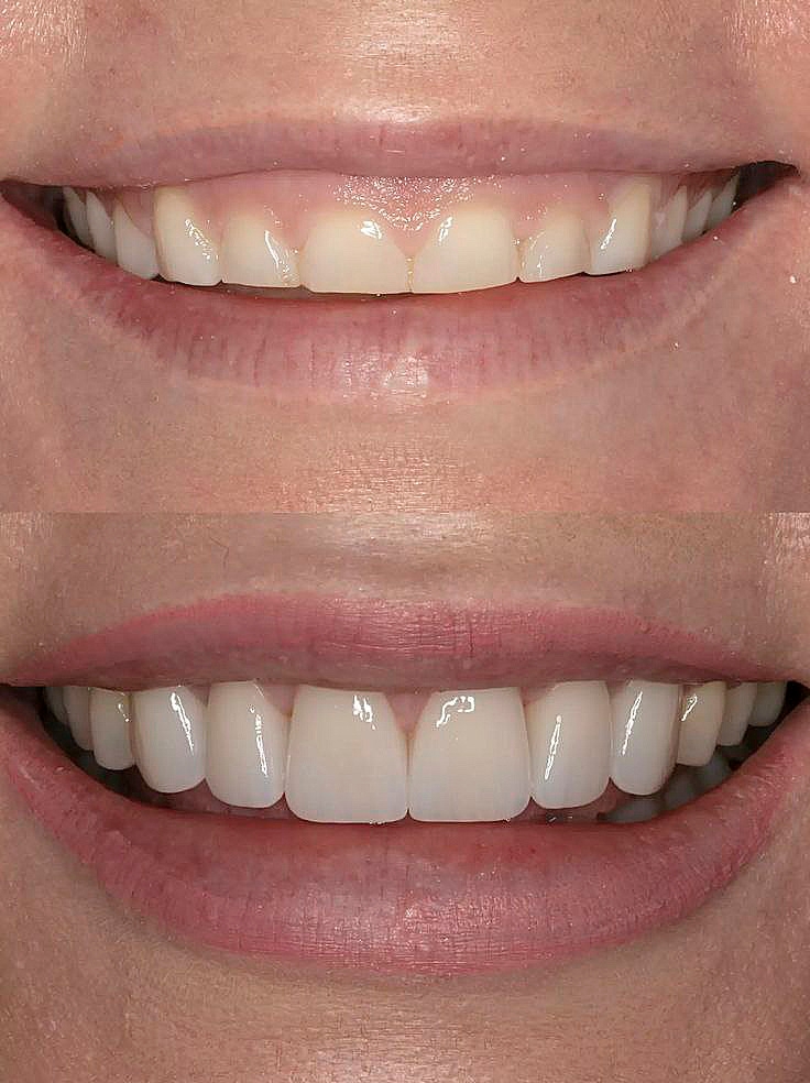 لیفت لثه در تهران