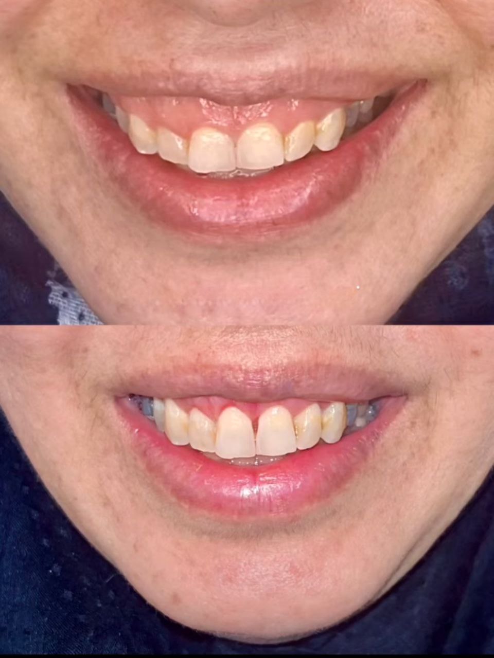 لیفت لثه در تهران