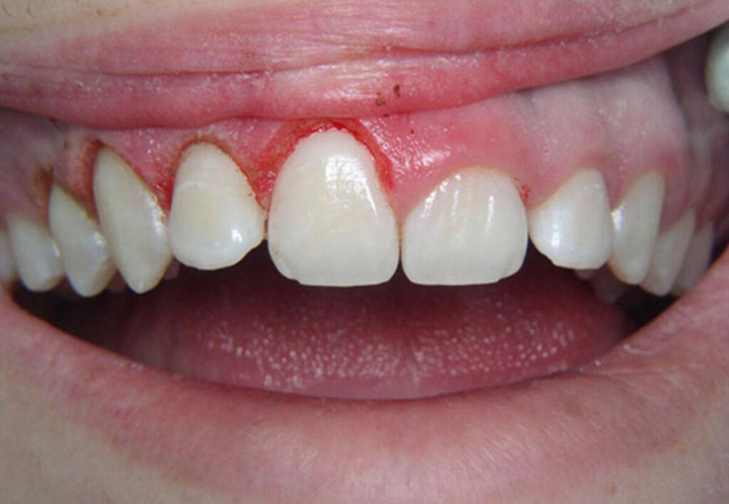 لیفت لثه در تهران