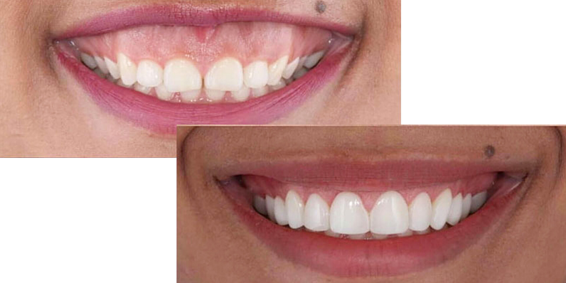 لیفت لثه در تهران