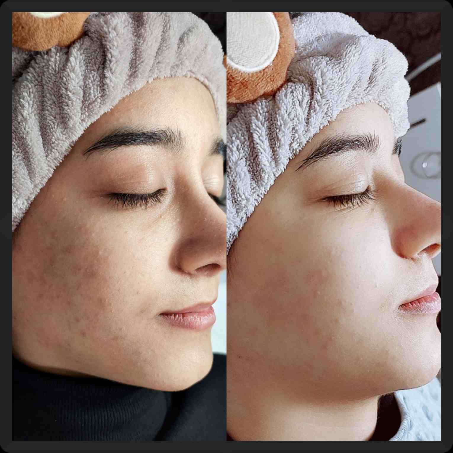 بهترین مرکز فیشیال پوست در شیراز