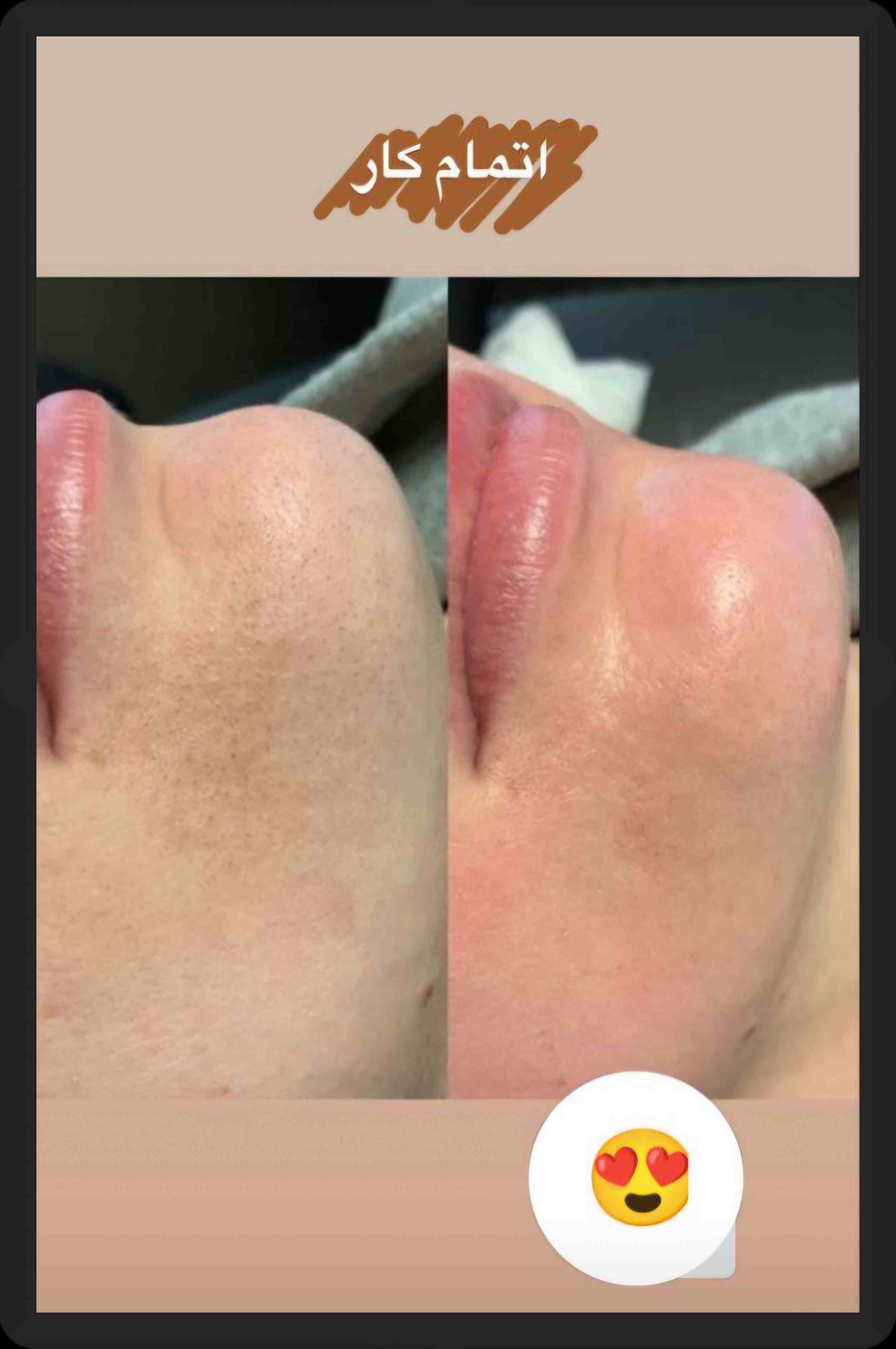 بهترین مرکز فیشیال پوست در شیراز