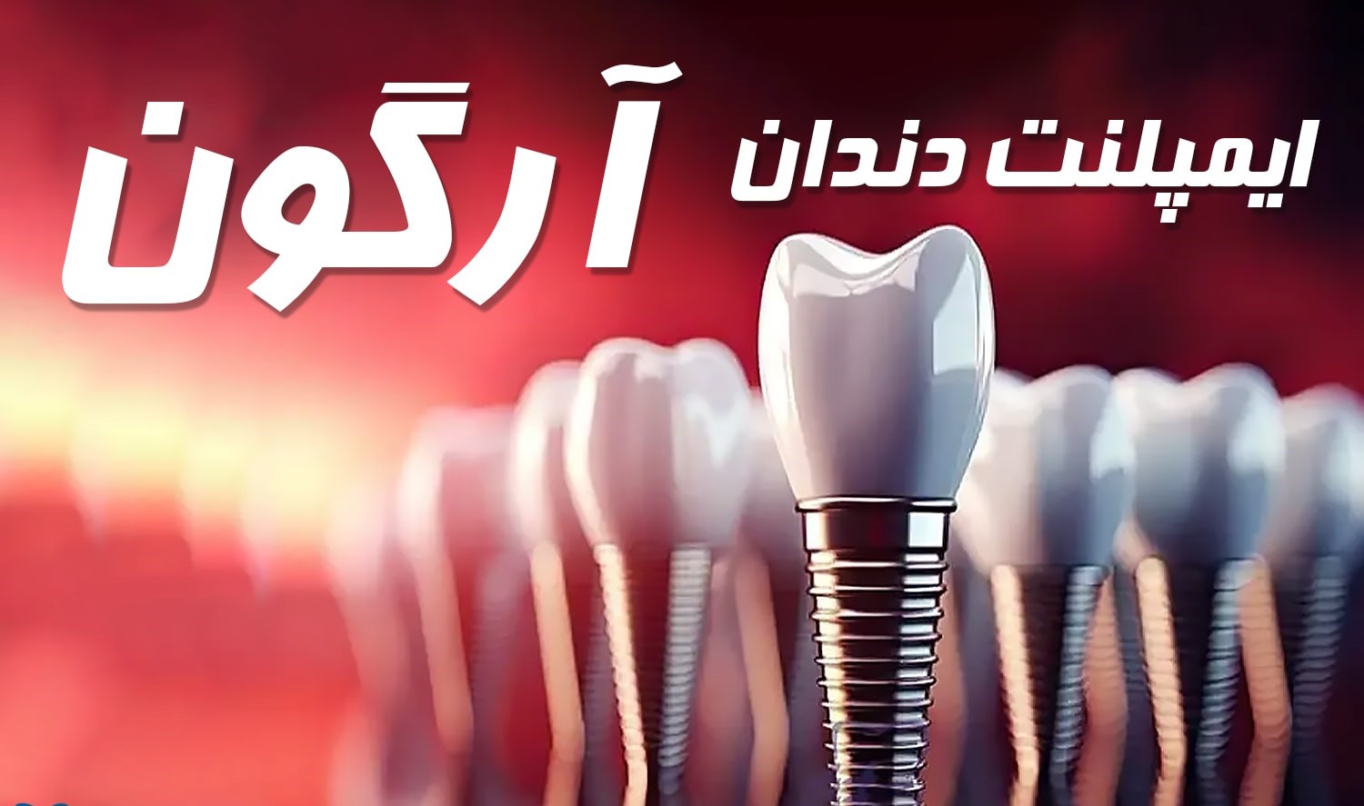 ایمپلنت آلمانی