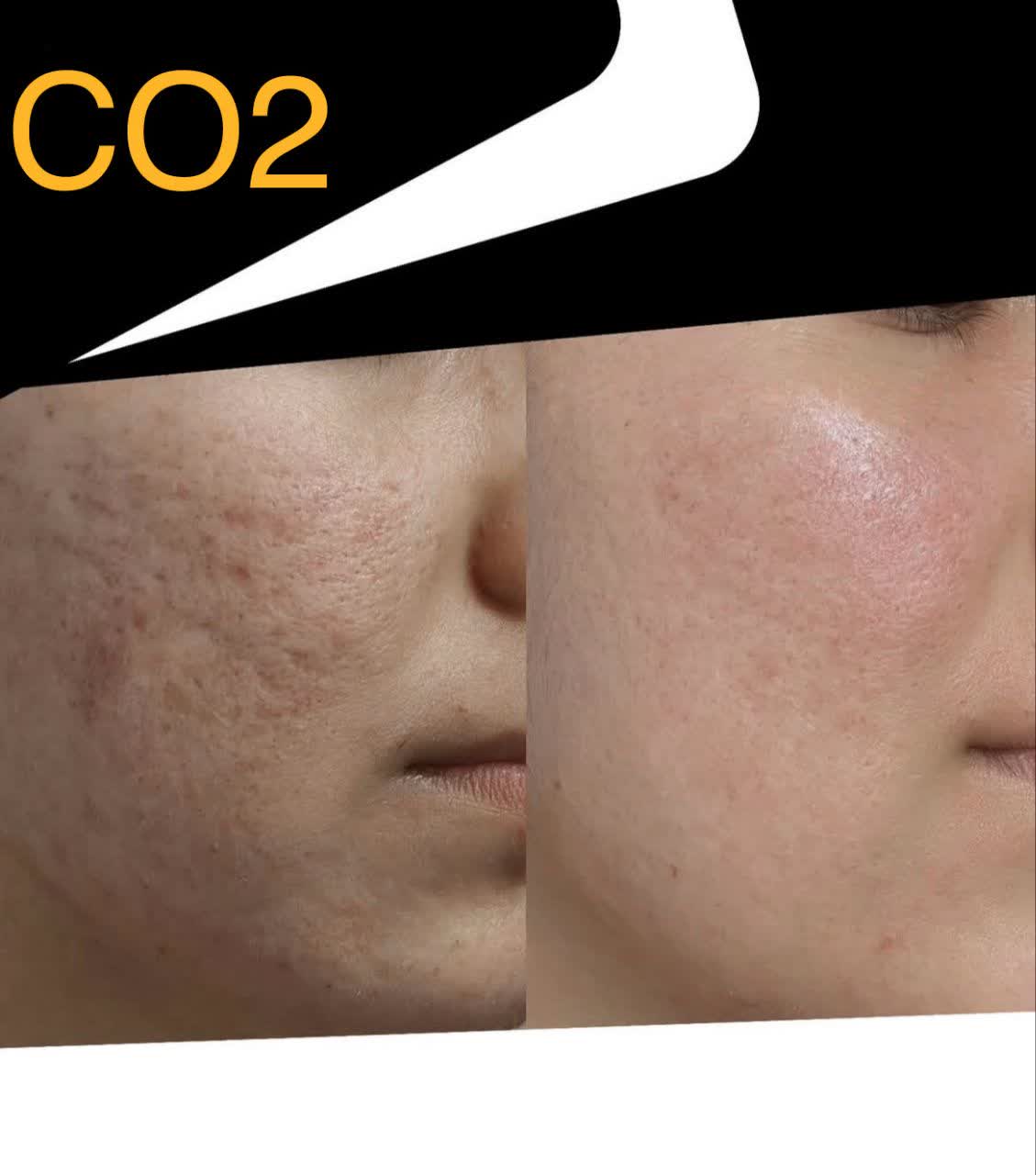 لیزر فرکشنال در بهترین کلینیک زیبایی در دزفول