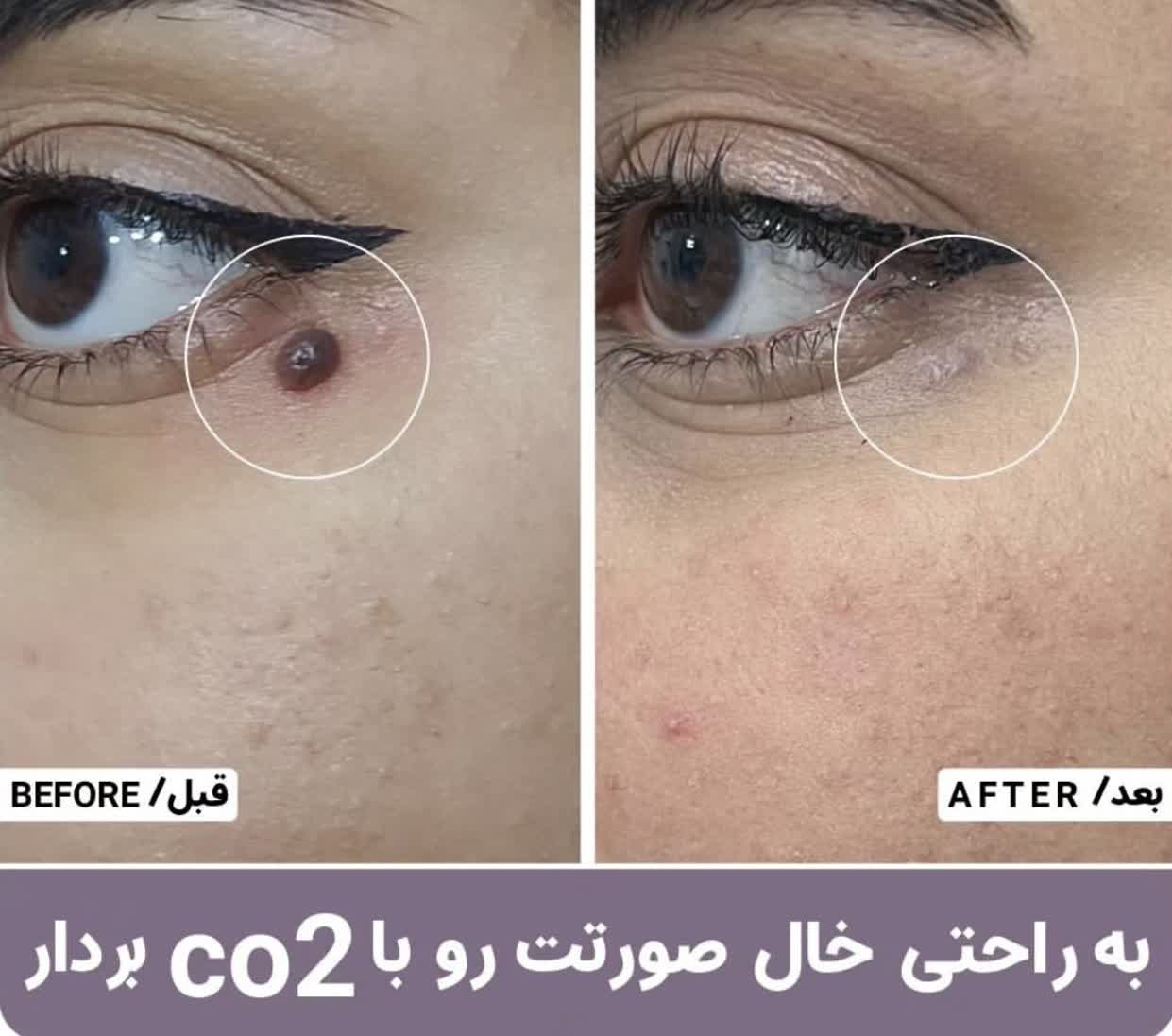 لیزر فرکشنال در بهترین کلینیک زیبایی در دزفول