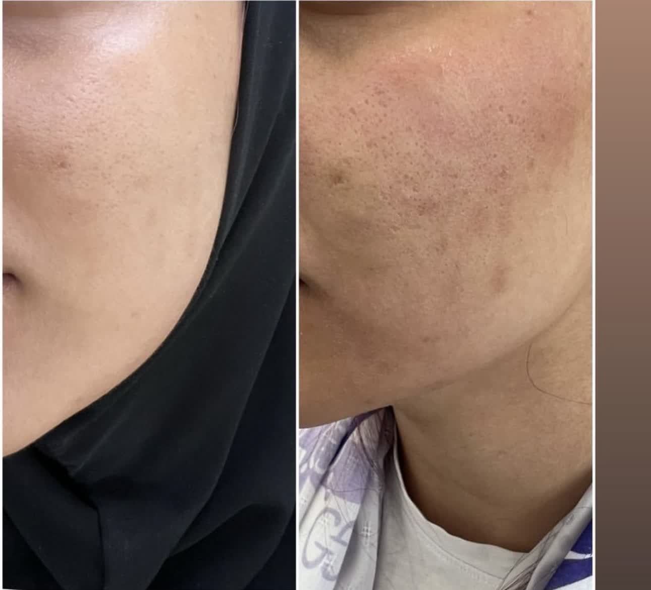 رفع جای جوش در بهترین کلینیک زیبایی دزفول