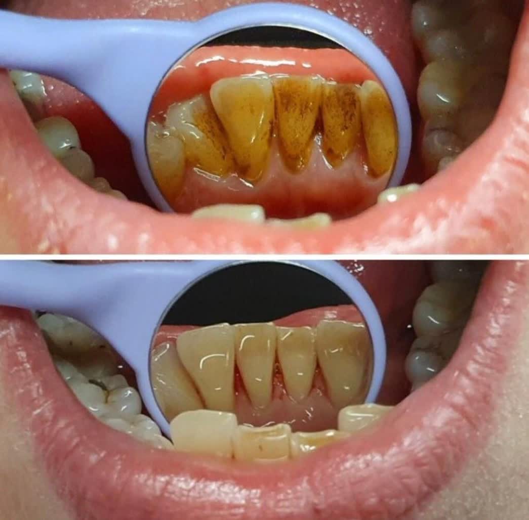 جرم گیری دندان در کرج