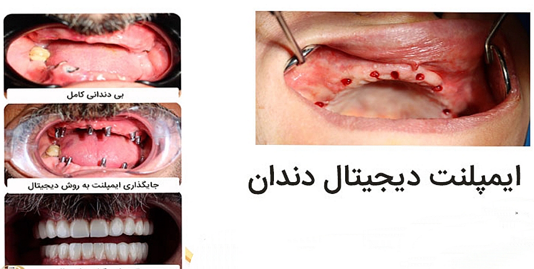 ایمپلنت در افسریه
