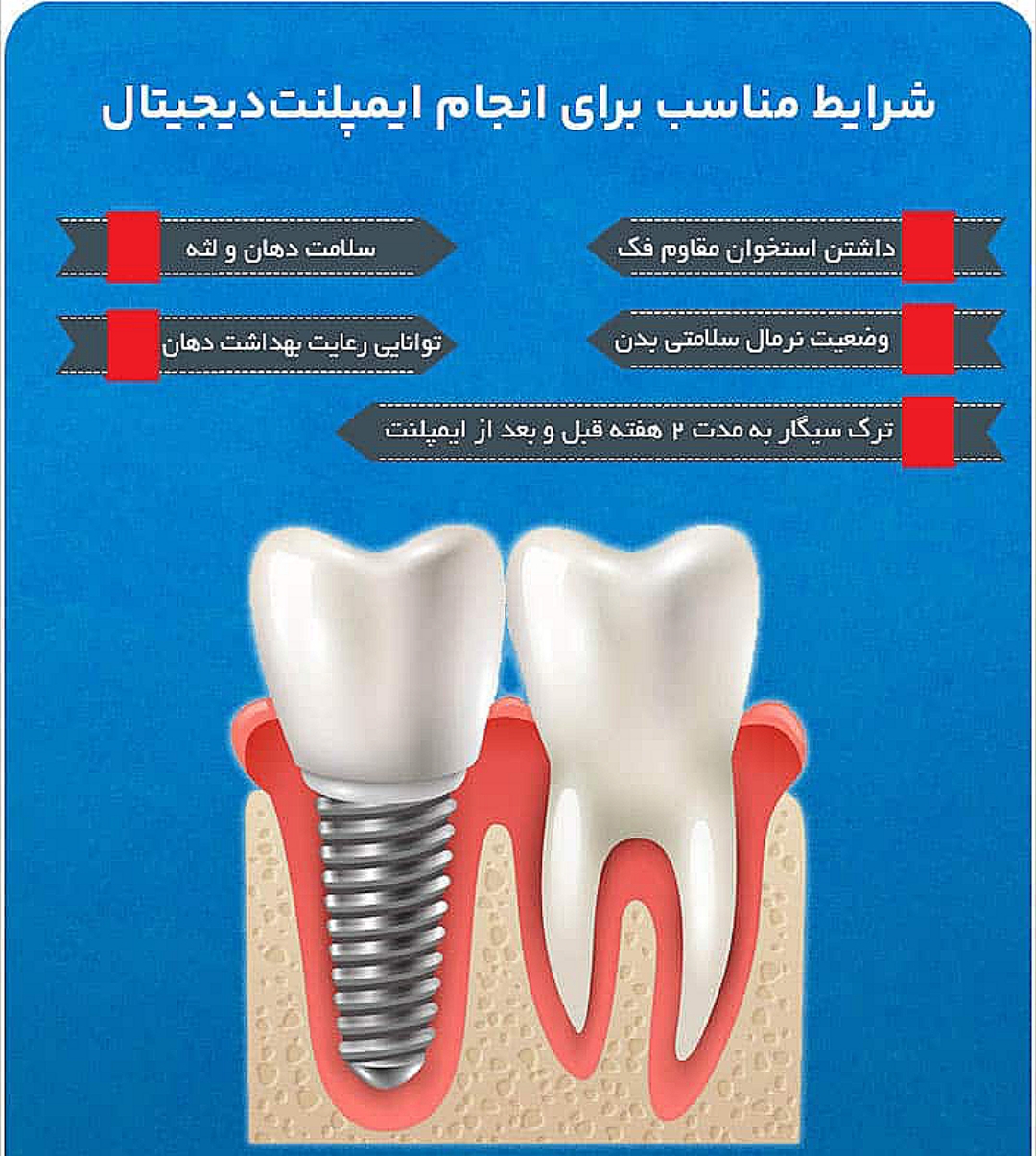 ایمپلنت در افسریه