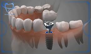 ایمپلنت در افسریه