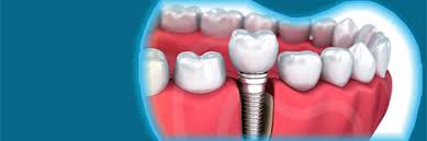 ایمپلنت در افسریه