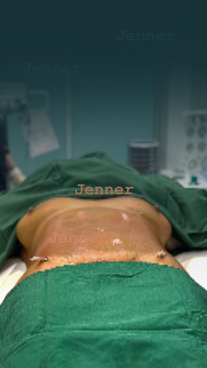 لیپوساکشن در کرج