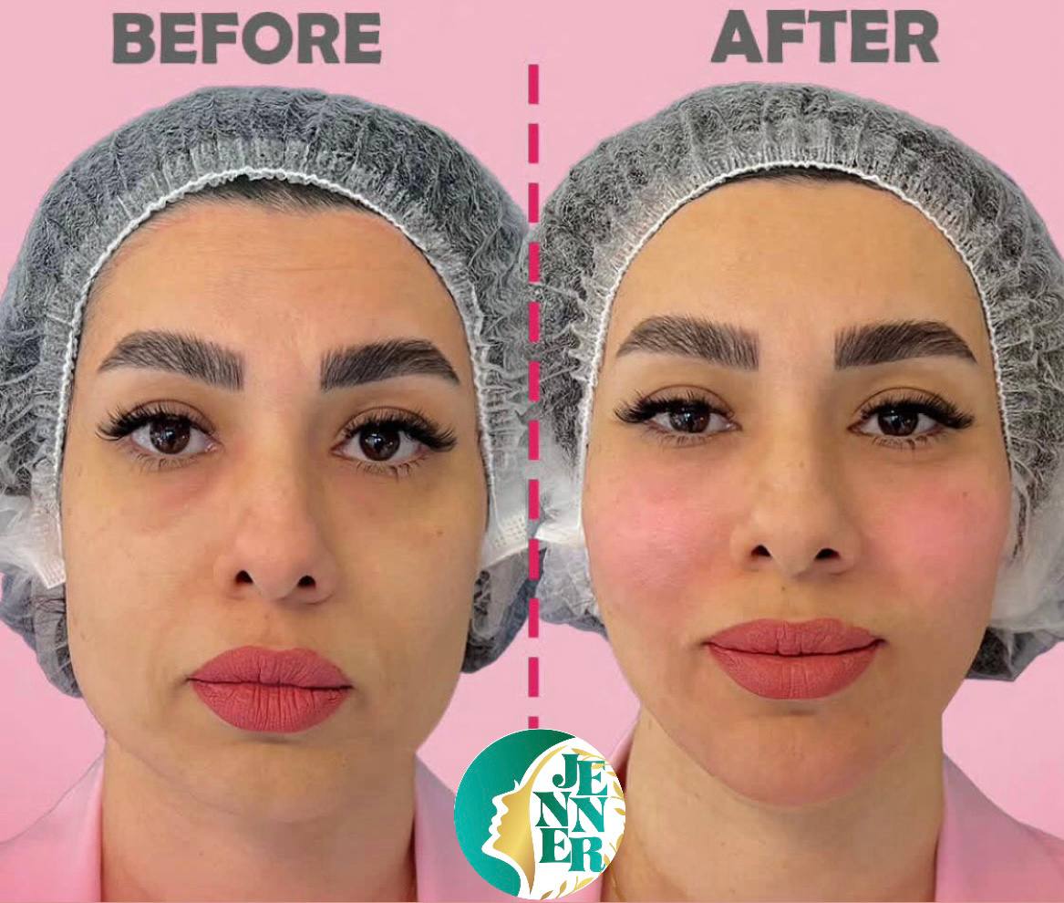 لیپوساکشن در کرج