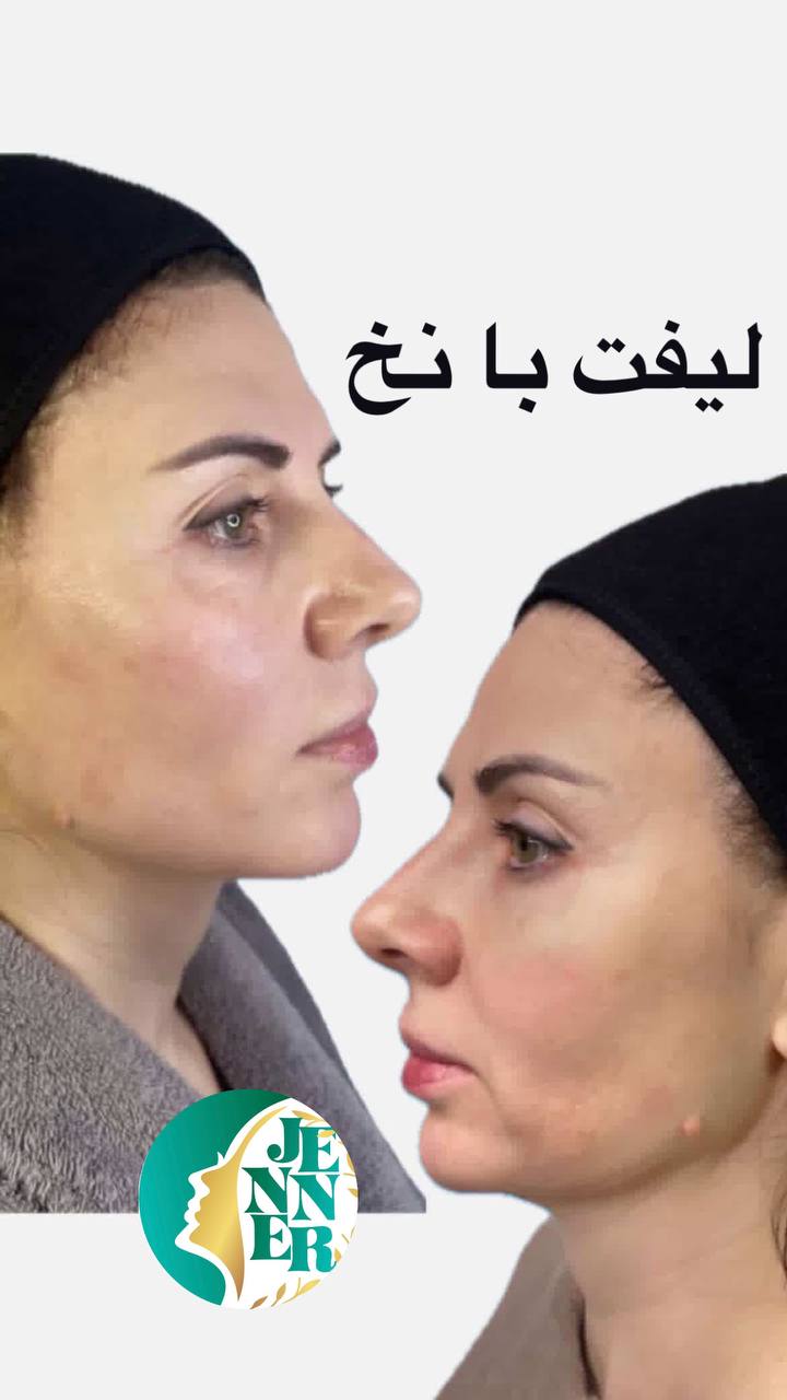 لیپوساکشن در کرج