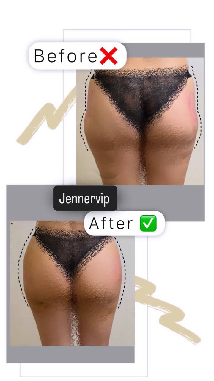 لیپوساکشن در کرج