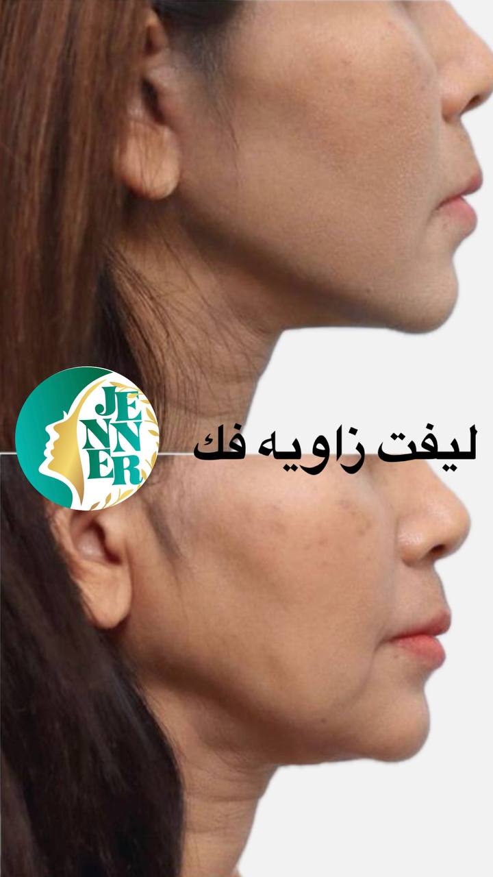 لیپوساکشن در کرج