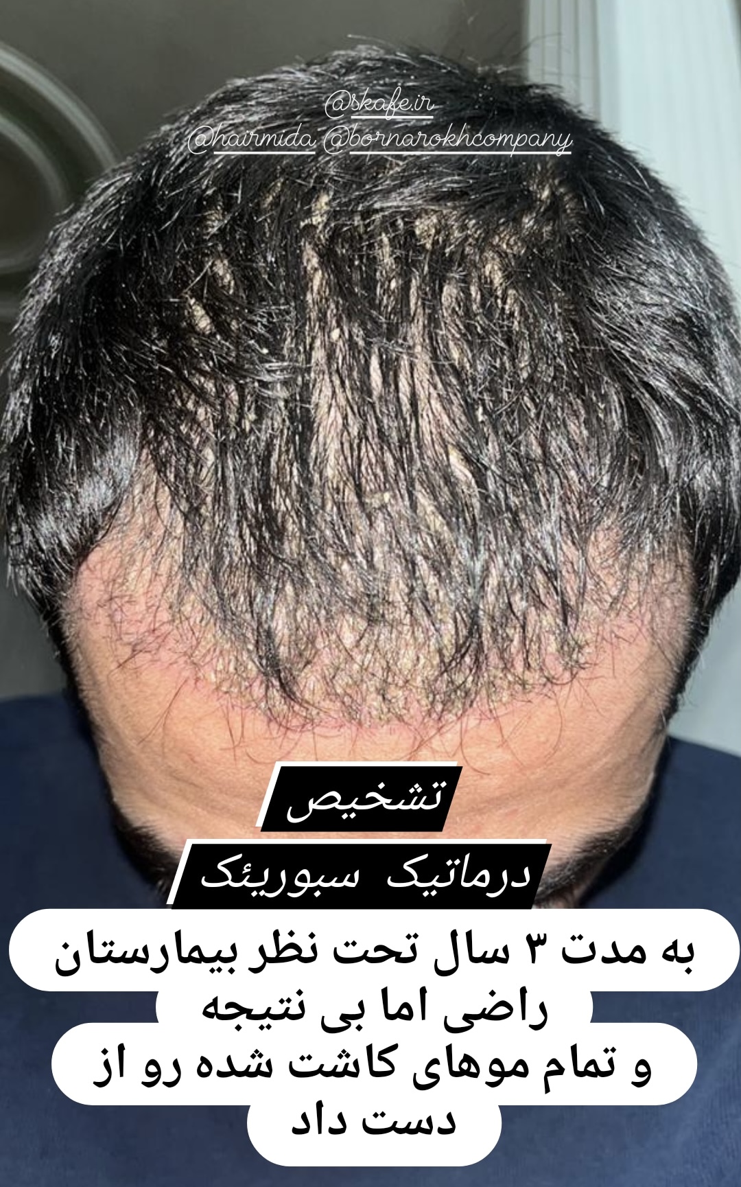 قبل درمان