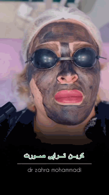 کربن تراپی صورت در چیتگر 