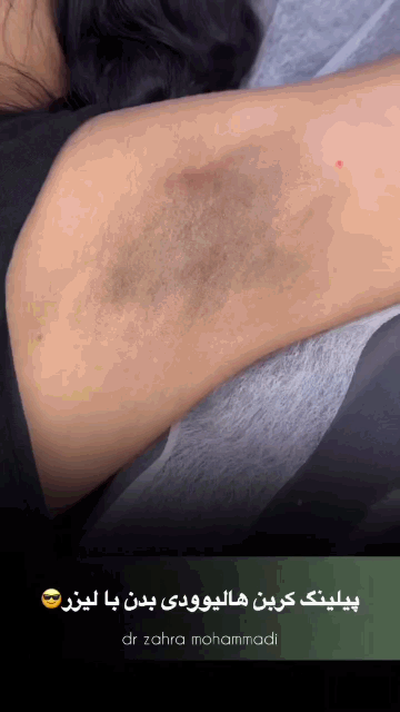 کربن تراپی در چیتگر تهران