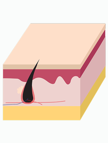 لیزر خانم ها در زاهدان
