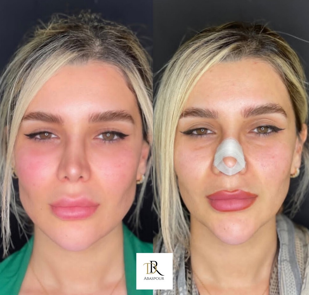 تزریق ژل و بوتاکس در اصفهان