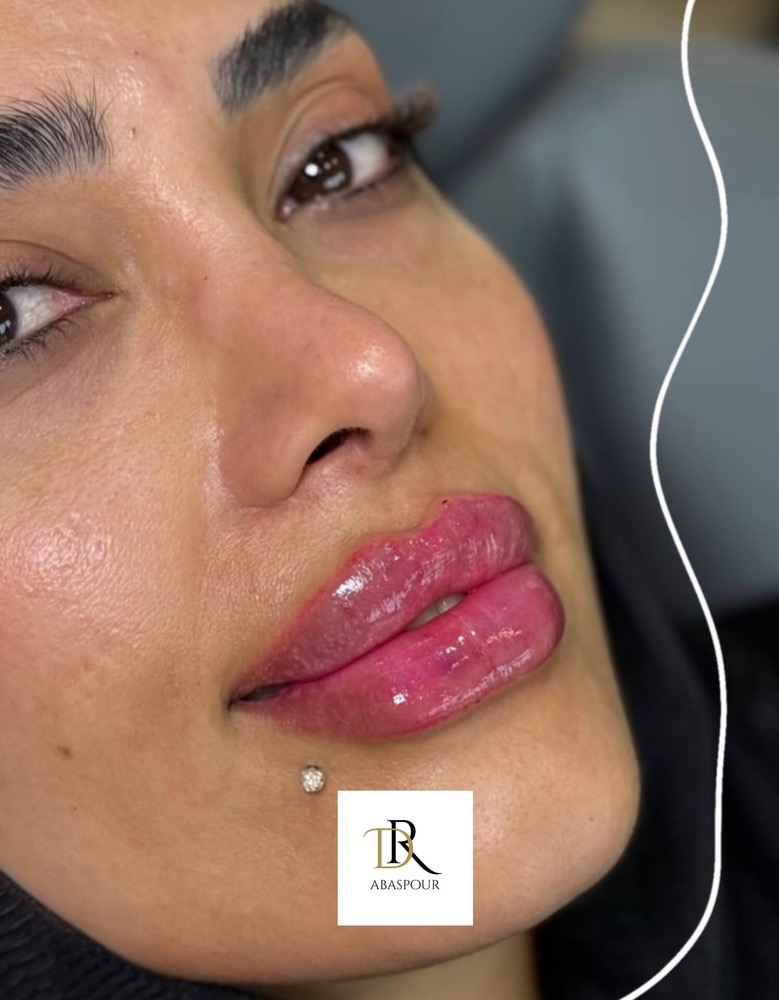 تزریق ژل و بوتاکس در اصفهان