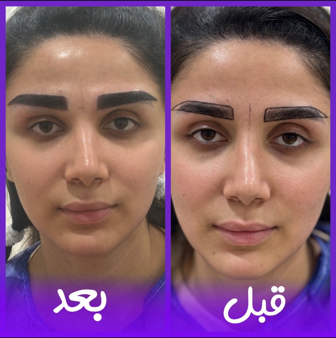 کاشت‌ابرو طبیعی‌کرج
