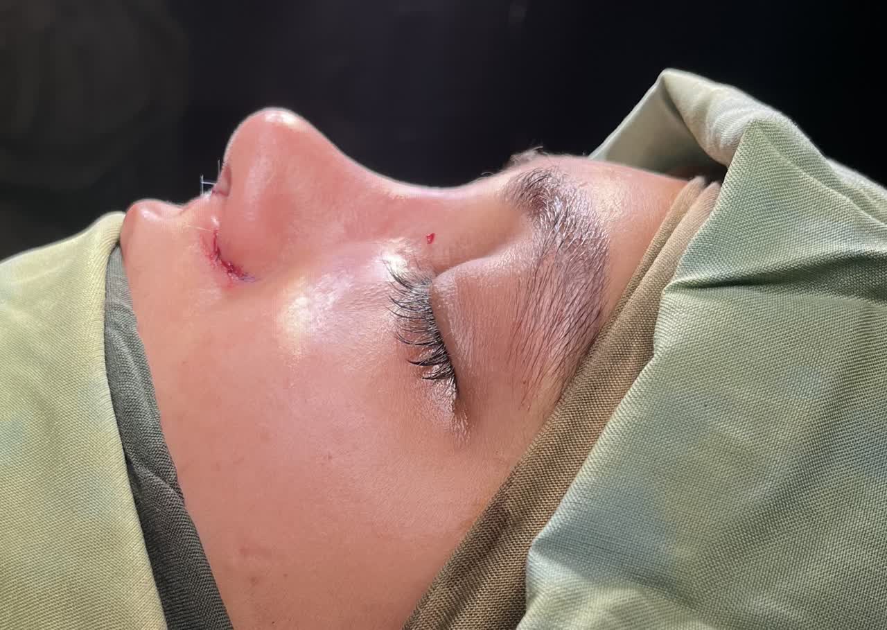 عمل طبیعی بینی در اصفهان
