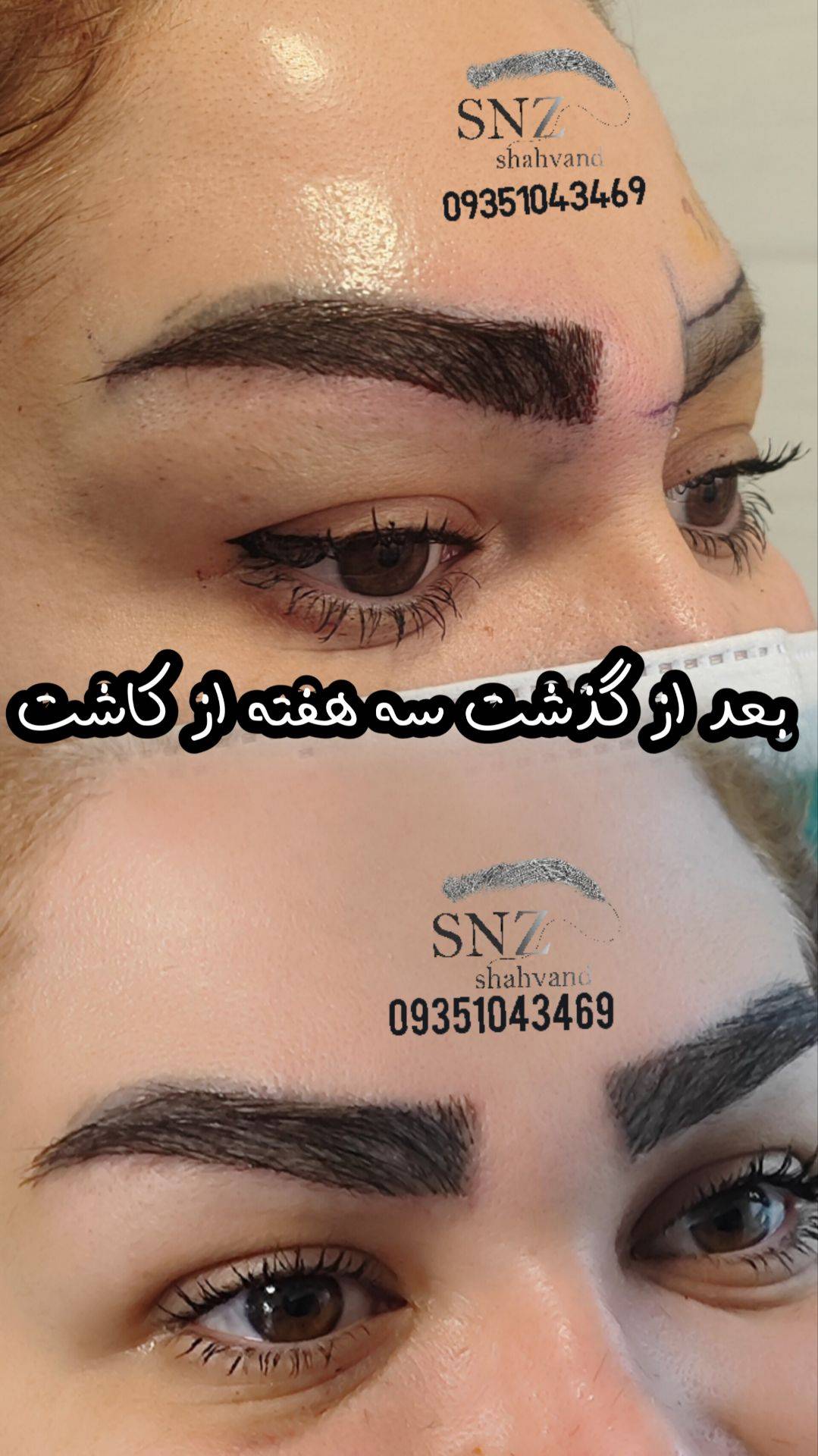 کاشت ابرو در شیراز