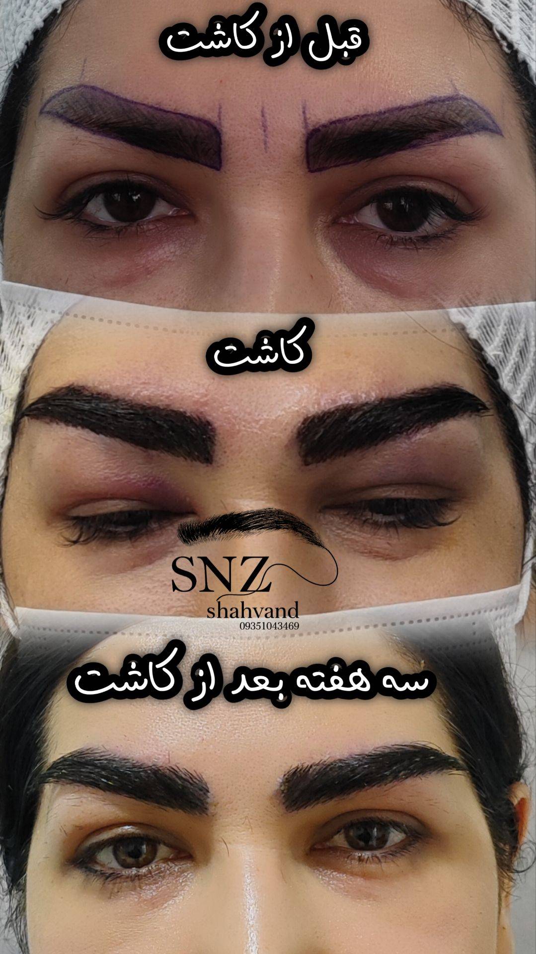 کاشت ابرو در شیراز