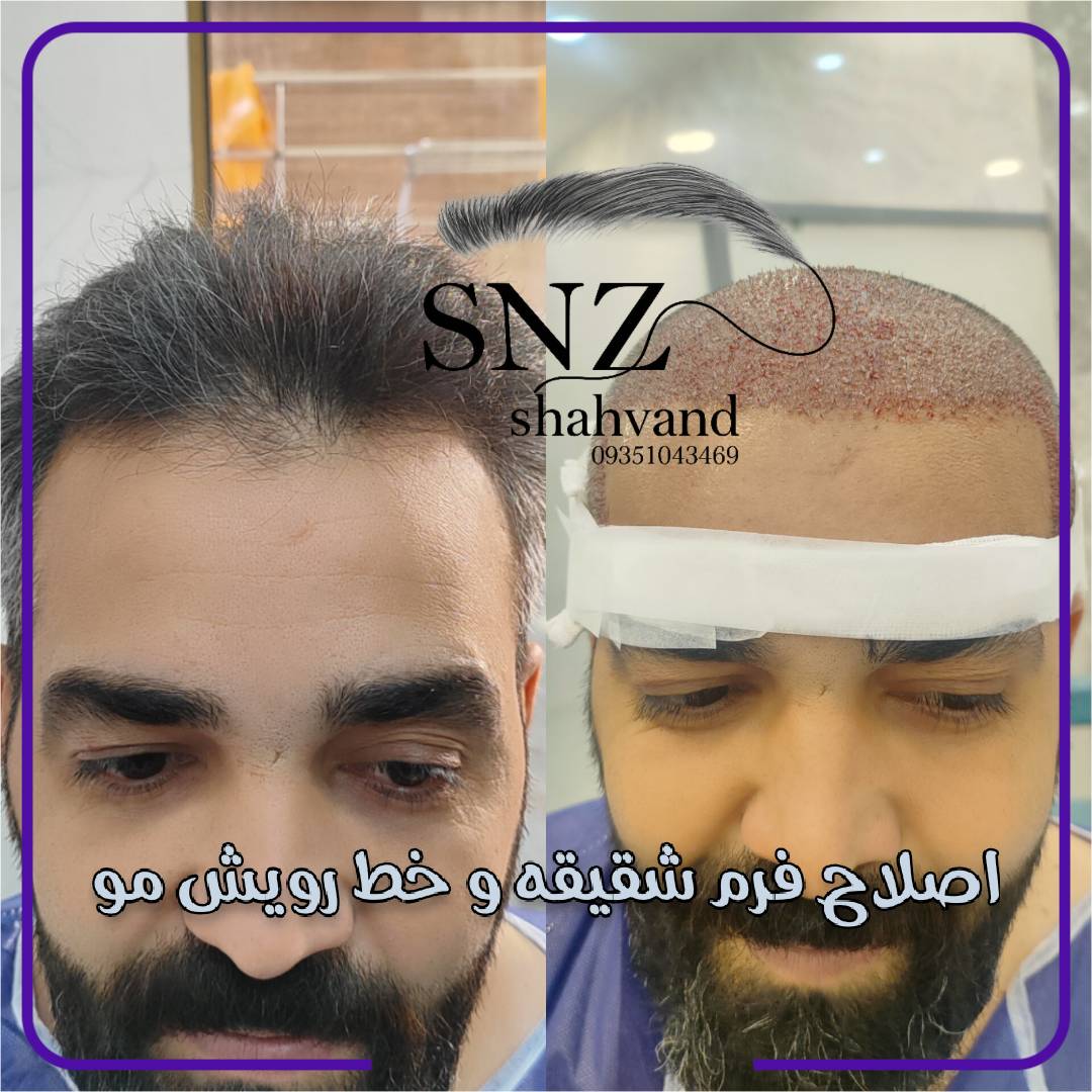کاشت ابرو در شیراز