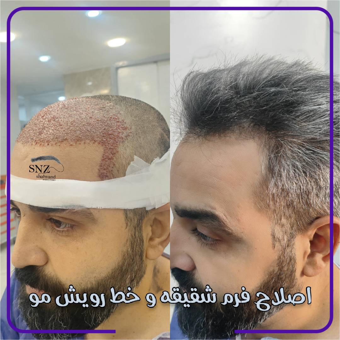 کاشت ابرو در شیراز