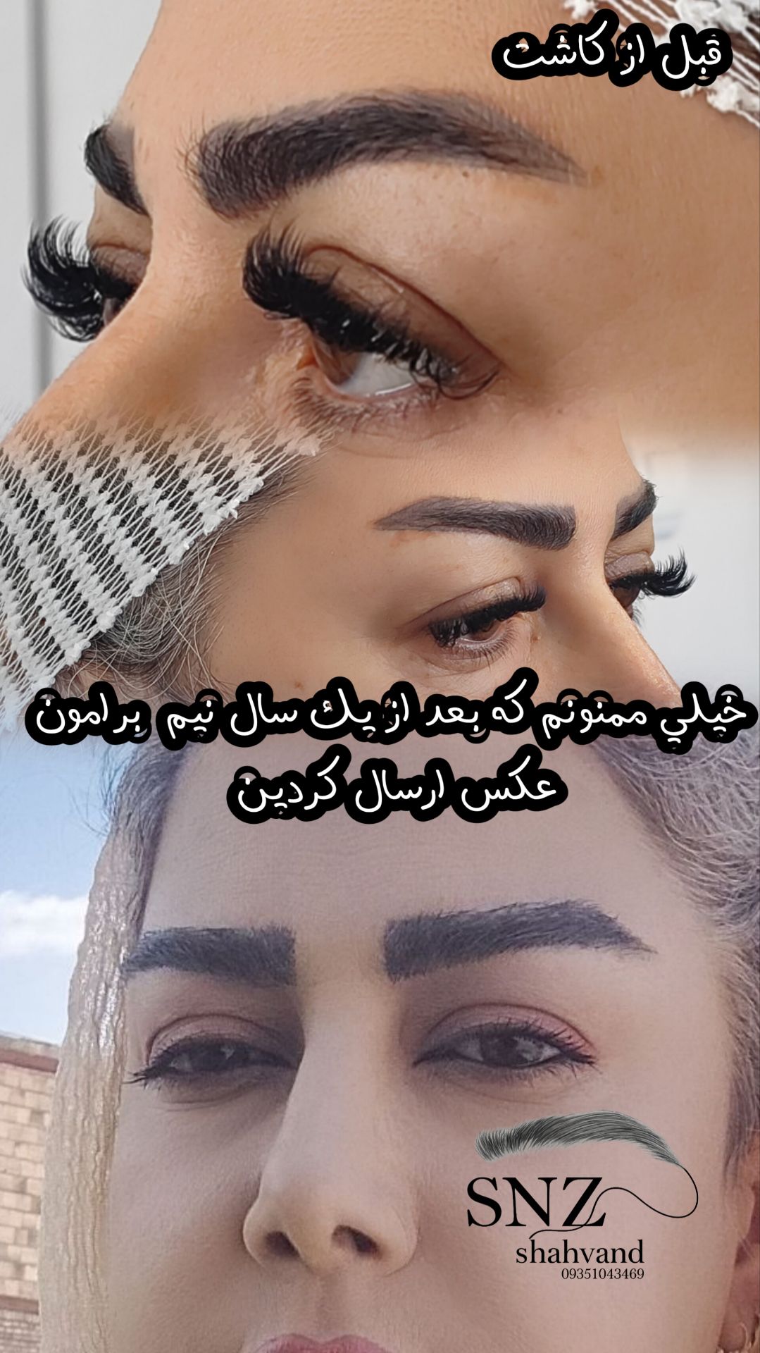 کاشت ابرو در شیراز