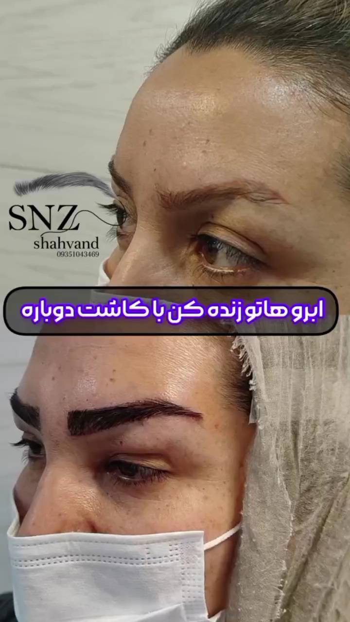 کاشت ابرو در شیراز