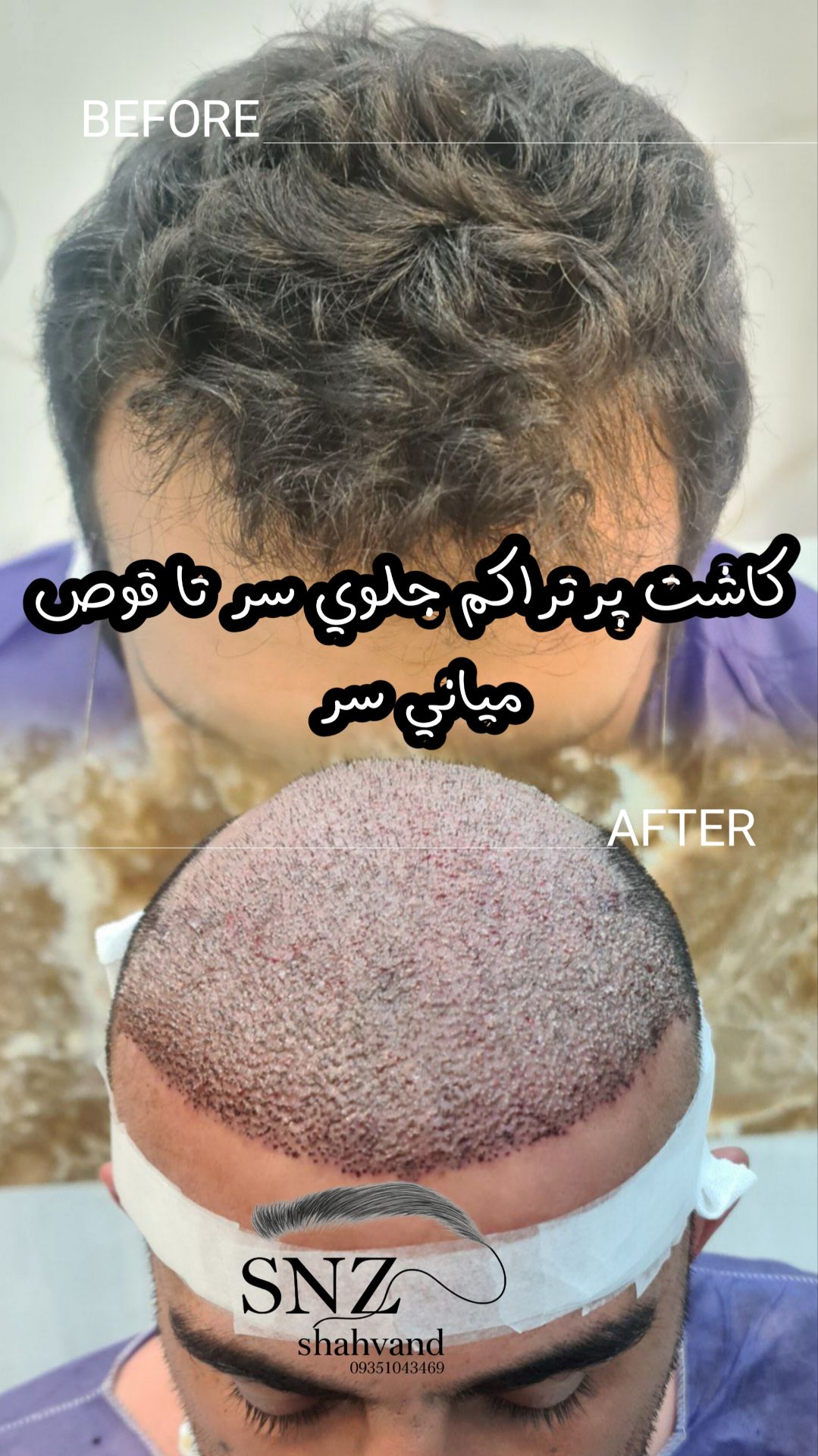 کاشت مو اقساطی  حرقه ایی در اصفهان