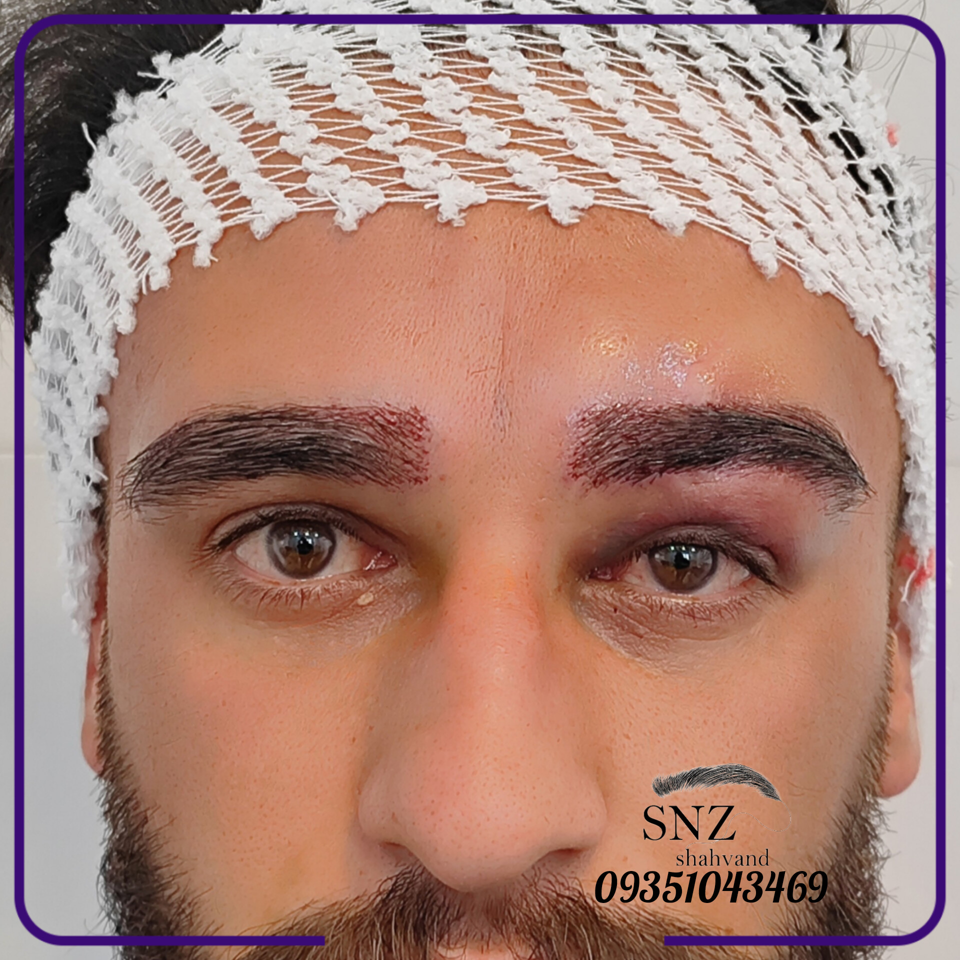 کاشت مو اصفهان
