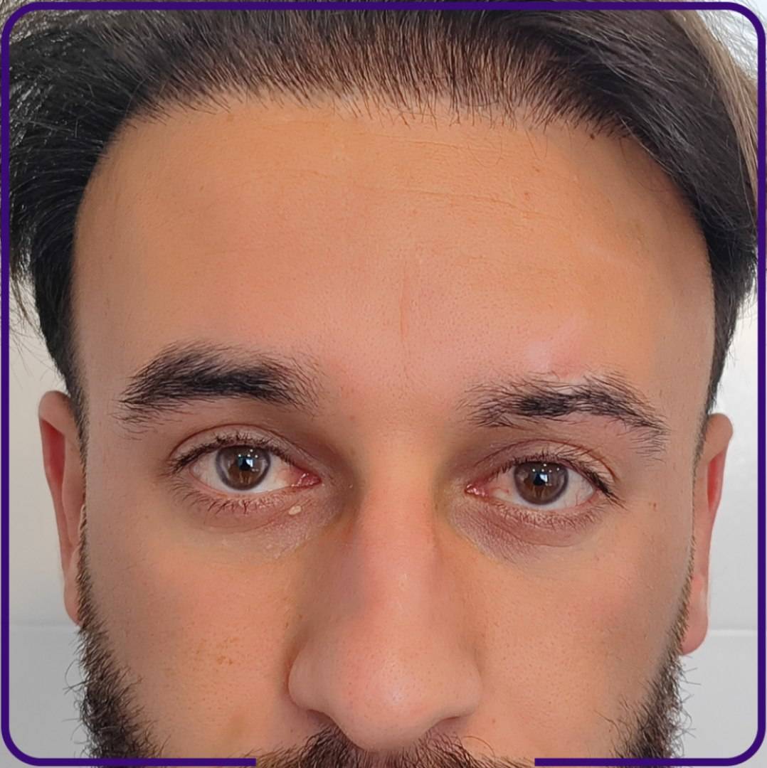 کاشت مودر اصفهان