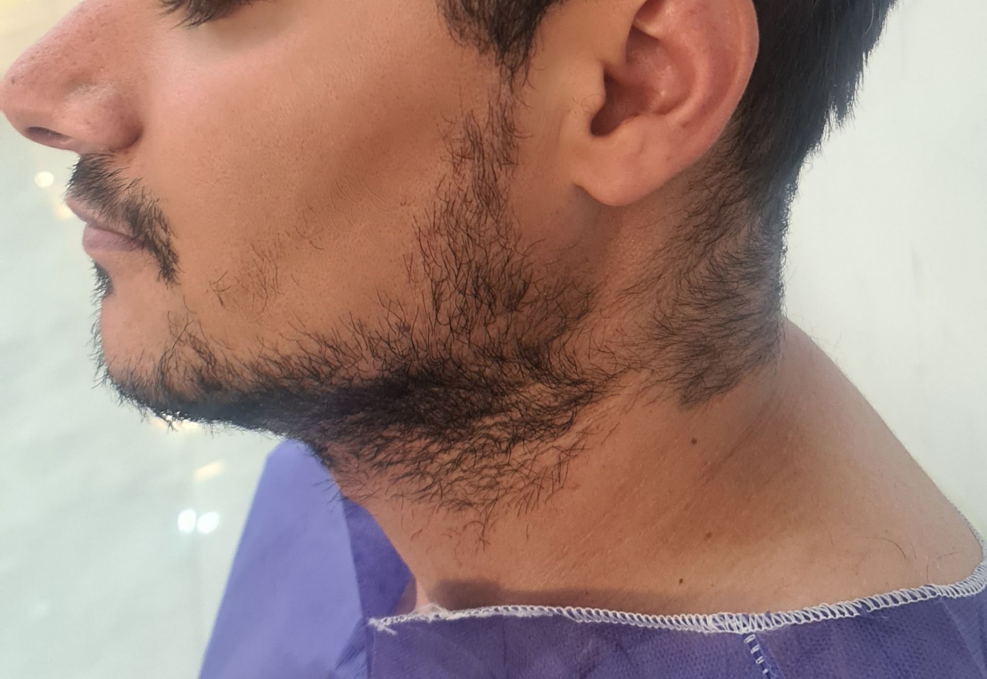 کاشت ریش اصفهان
