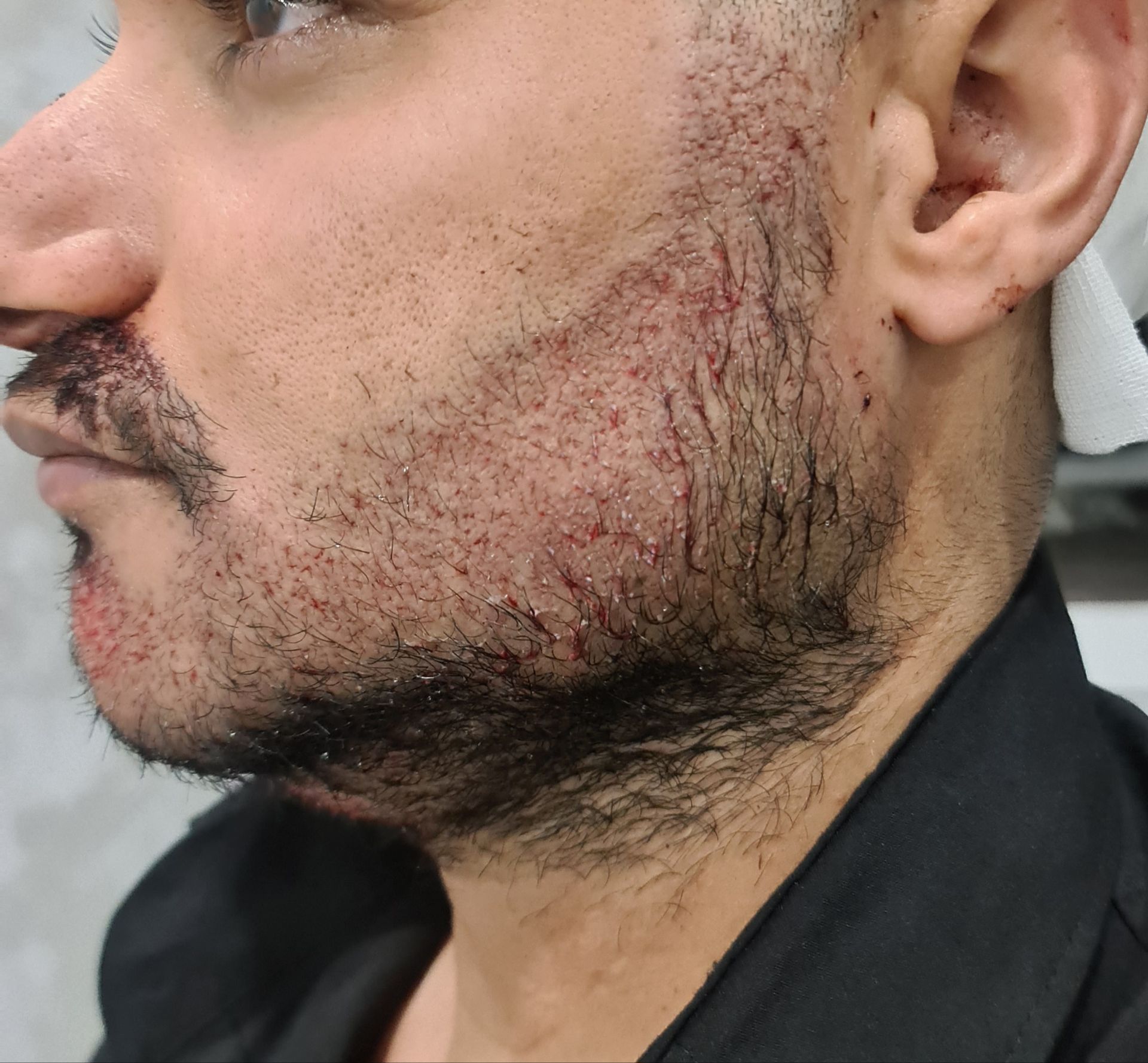 کاشت  ریش در اصفهان