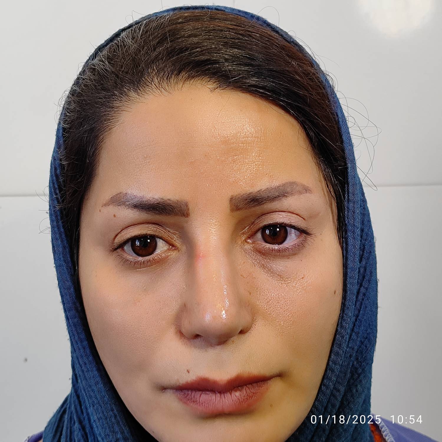 قیمت کاشت ابرو  اصفهان