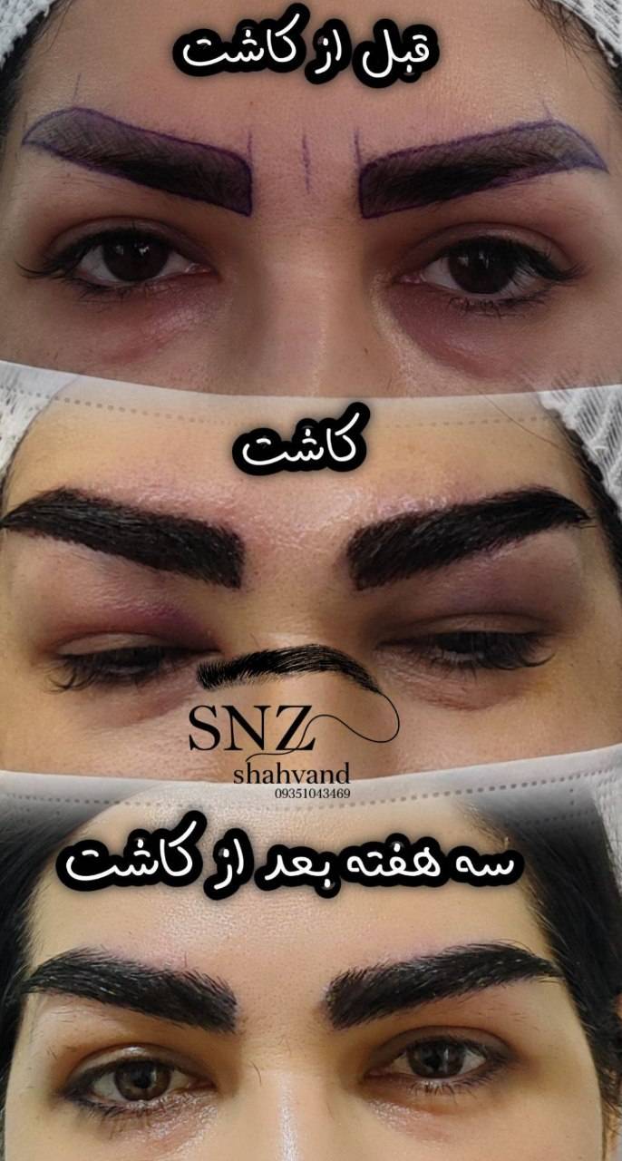 مجموعه تخصصی کاشت مو و ابرو ساناز شهوند