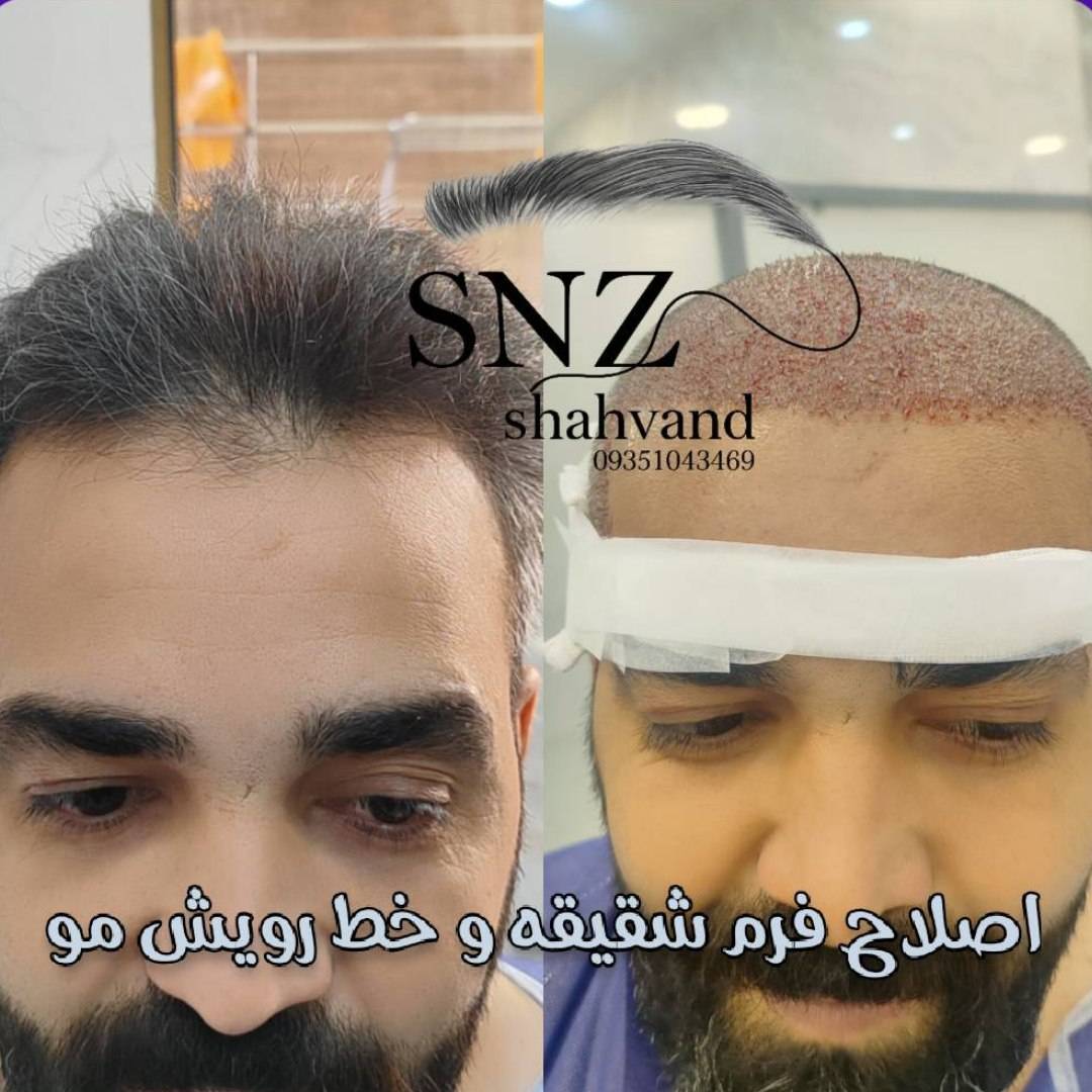 مجموعه کاشت مو و ابرو ساناز شهوند
