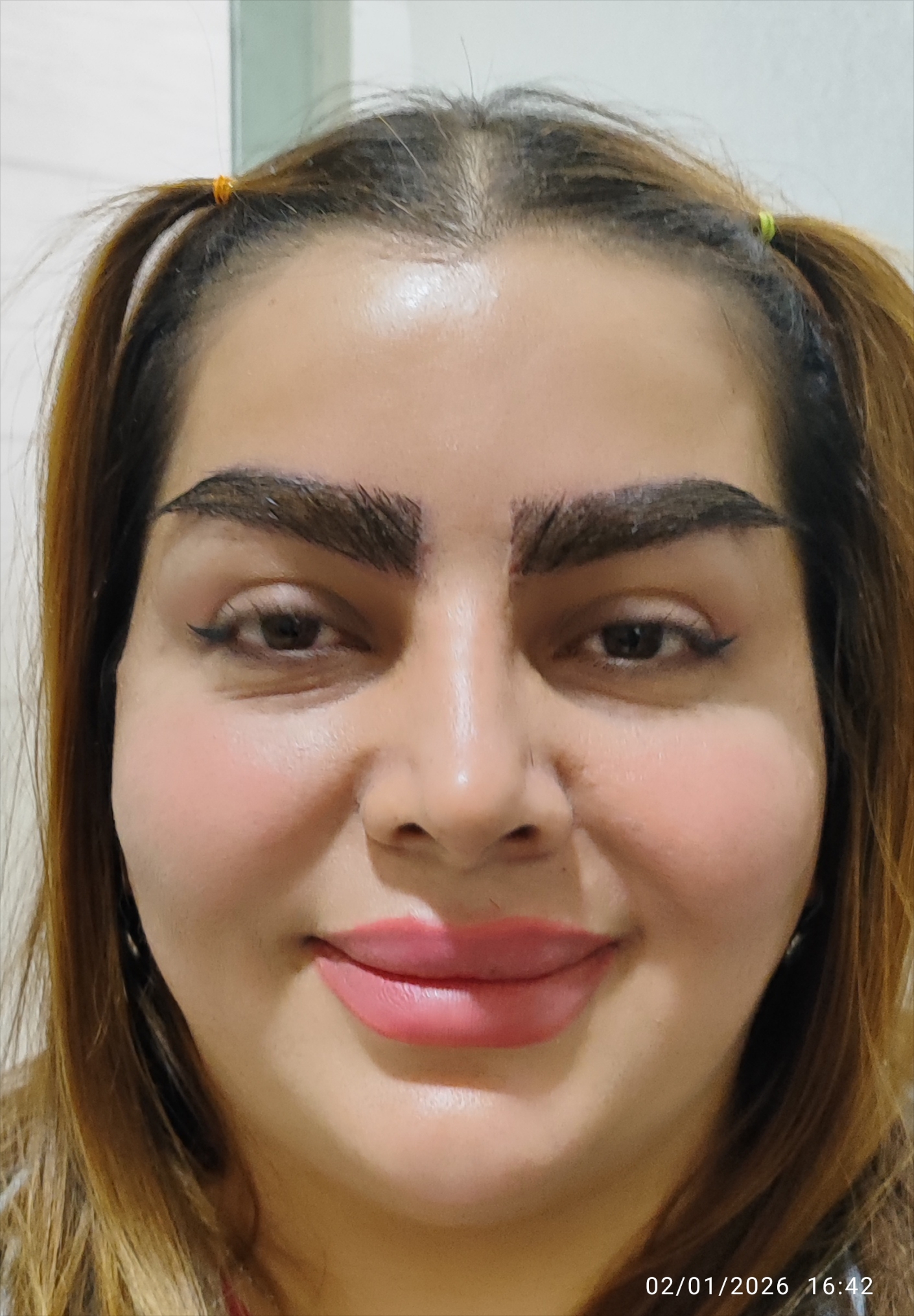 کاشت مو اقساطی در اصفهان