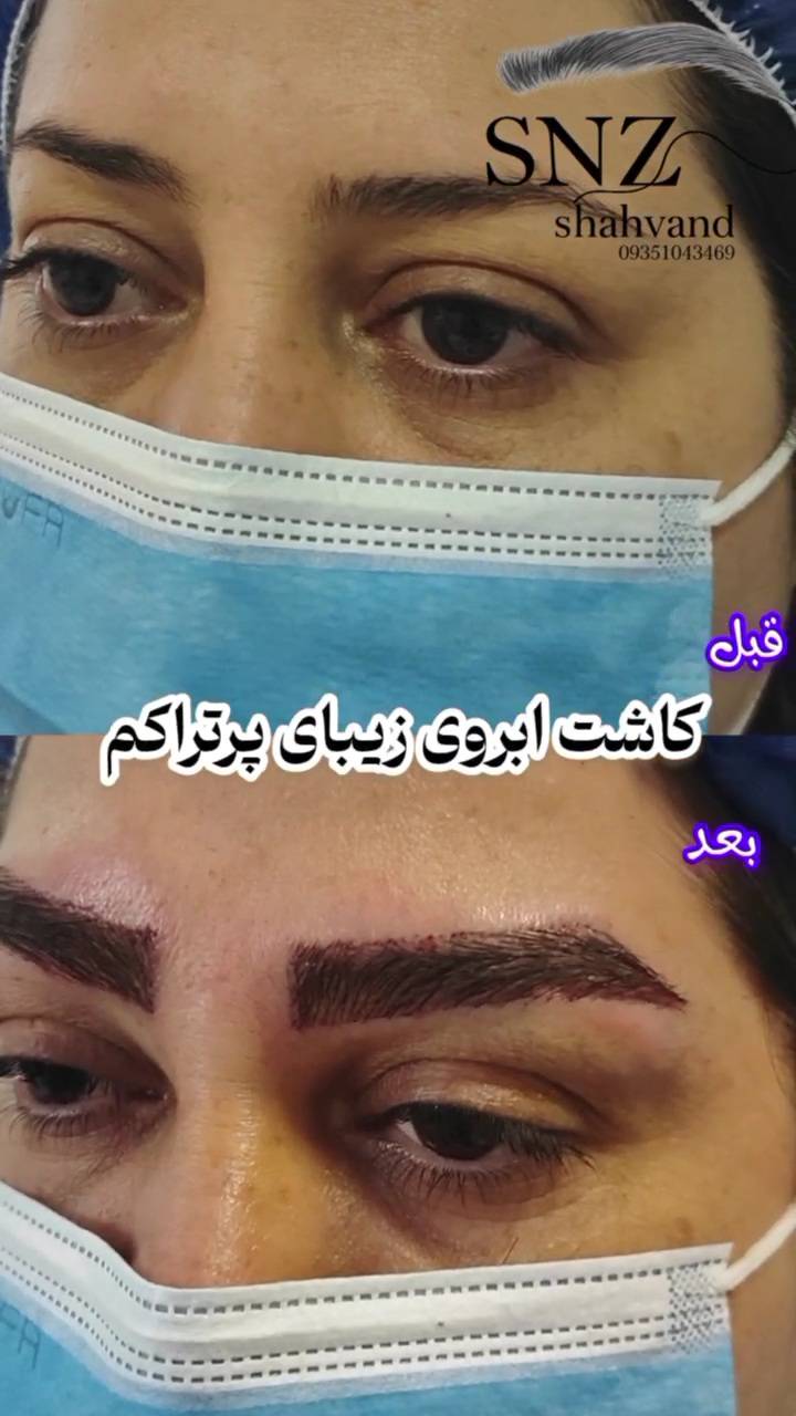 کاشت مو اقساطی در اصفهان