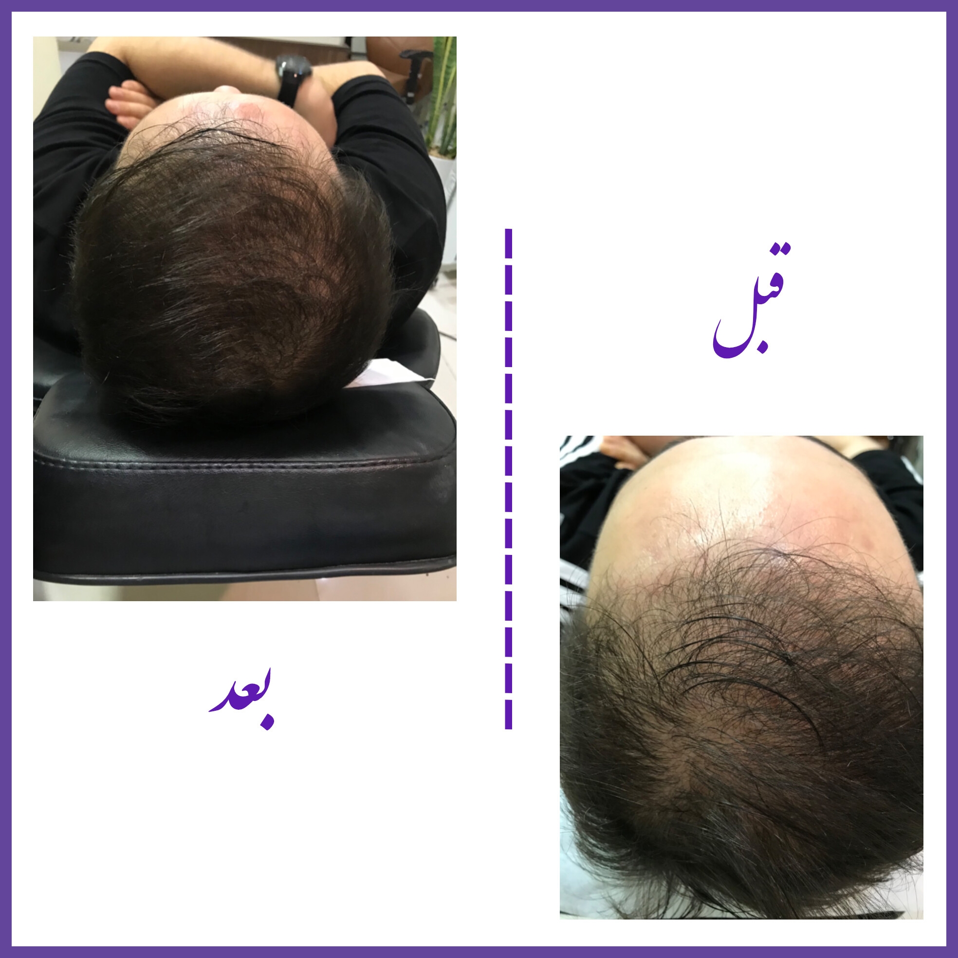 مزوتراپی