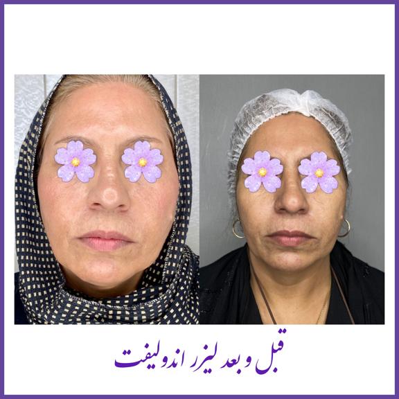 تصاویر قبل و بعد