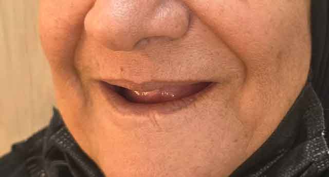 طراحی و ساخت دندان‌های مصنوعی (دست‌دندان کامل):