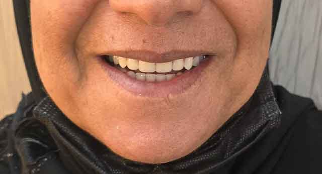 طراحی و ساخت دندان‌های مصنوعی (دست‌دندان کامل):